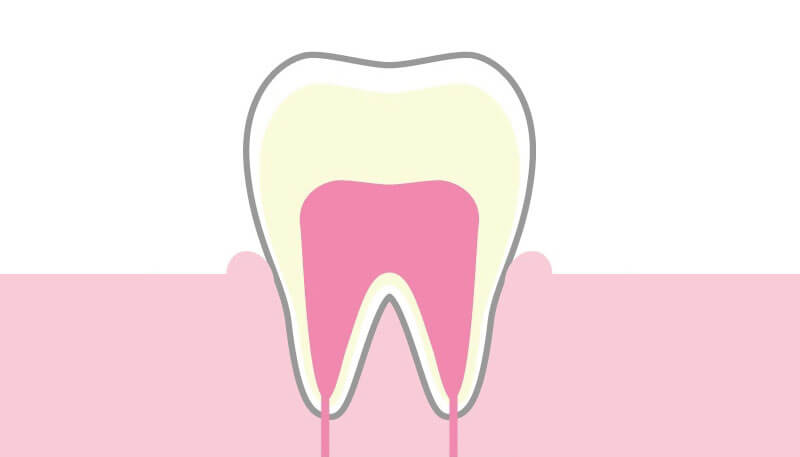 C0：初期の虫歯