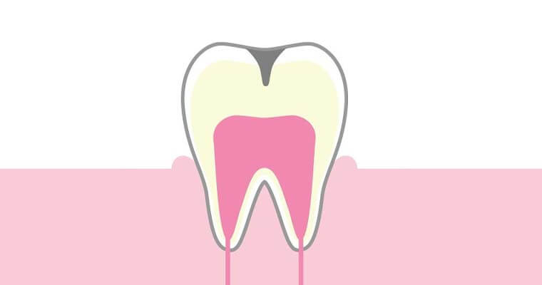 C1：エナメル質内のう蝕