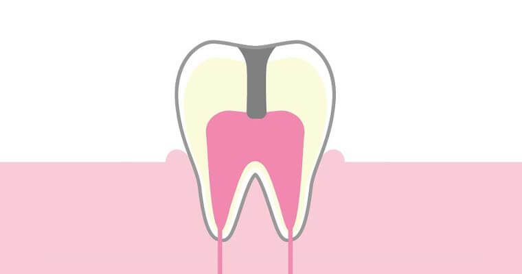 C3：歯髄(神経)に達したう蝕