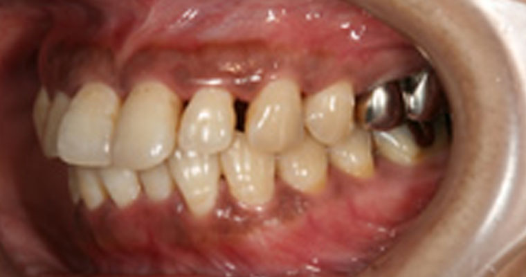 重度の歯周病②